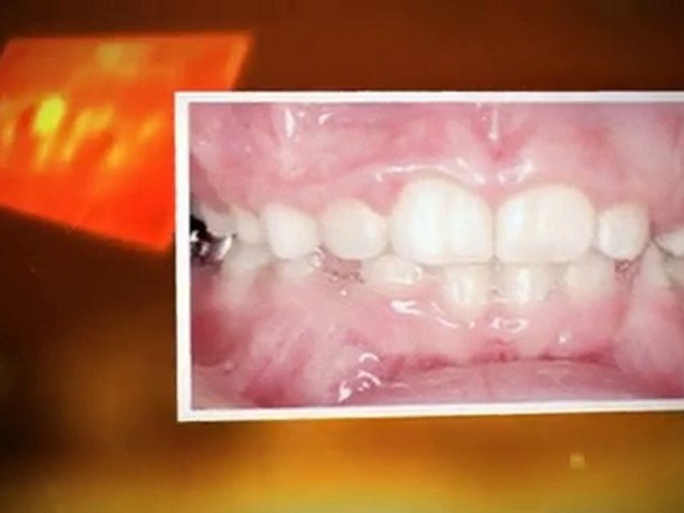 Orthodontist Fort Collins - Ebert Orthodontics