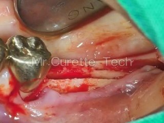 Mr.Curette Co.'s Bone Expander