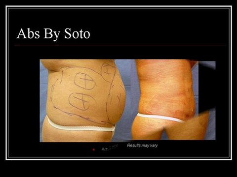 Laser Lipo Before and After Pictures / Dr. Efrain Soto