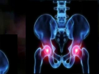 Hip Recall Lawyers