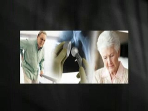 Depuy Hip Recall Lawyers