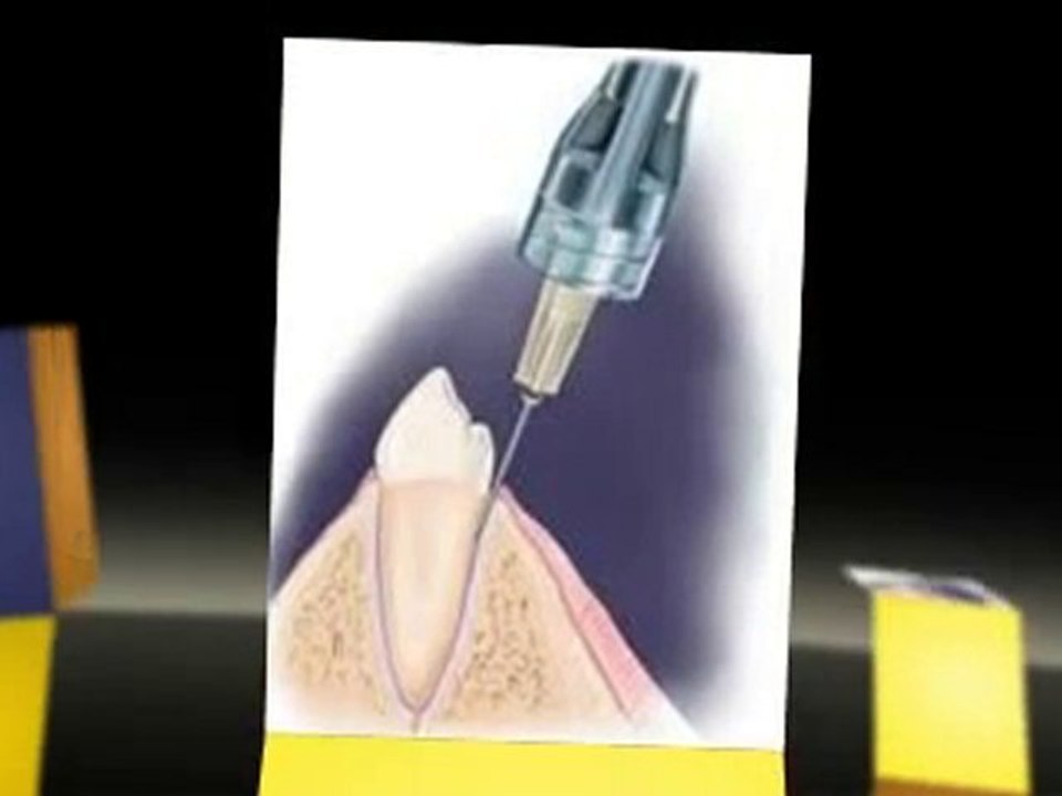 The Truth about Root Canal Treatments