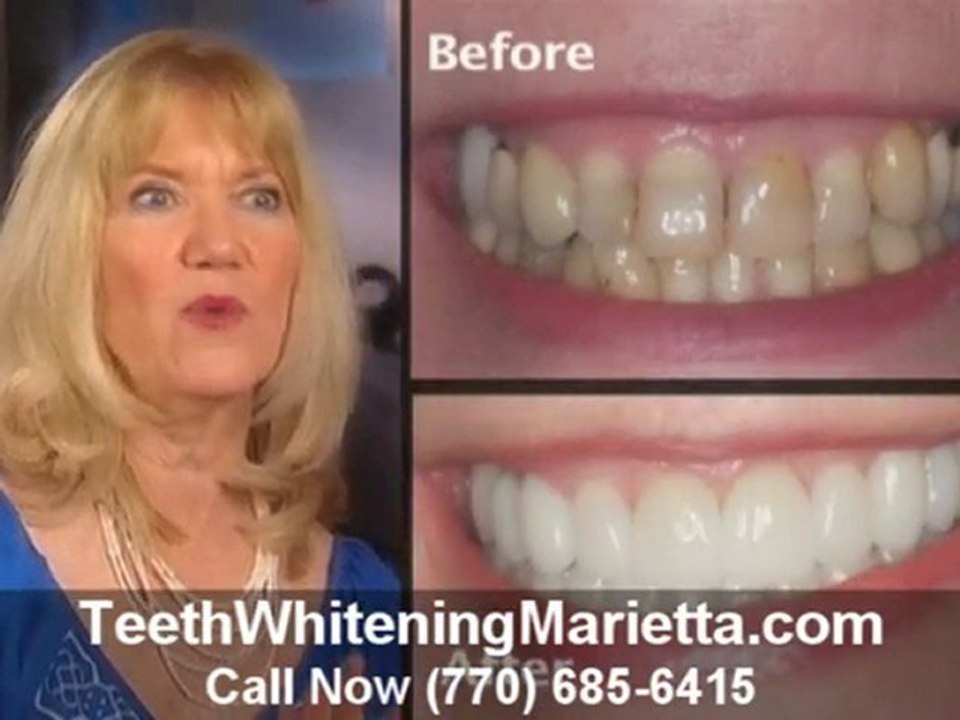 Teeth Whitening Marietta