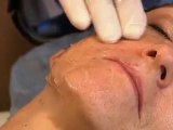 Pelleve by Dr. Michael Stampar Punta Gorda FL plastic surge