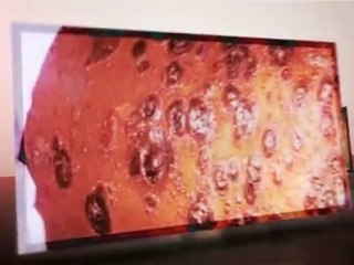 // Tratamentpsoriasis // Psoriasis forum | Psoriazis forum