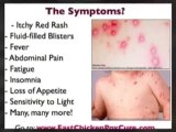 Fast Chicken Pox Cure - How To Cure Chicken Pox