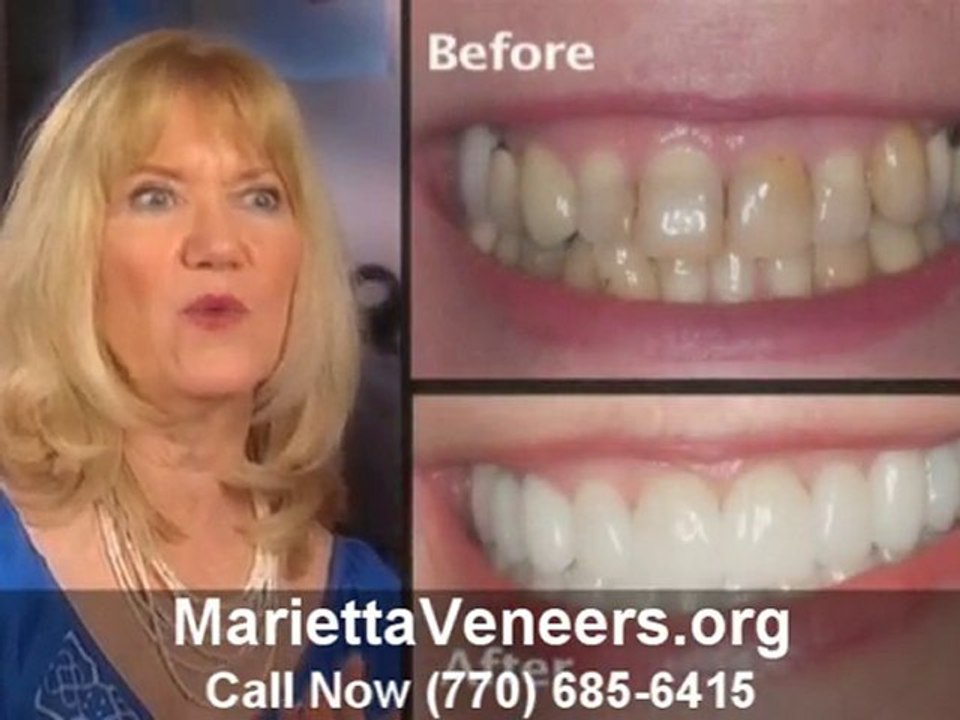 Marietta Veneers