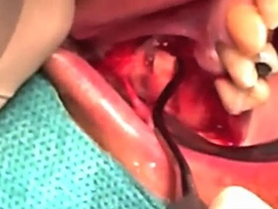 SINUS LIFT DR TAMMAM RUBEN 1ere partie