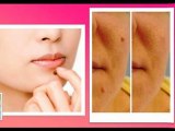 Skin Tags How To Remove - How To Remove Your Moles, Warts &