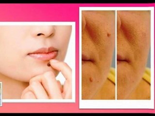Skin Tag Removal At Home - How To Get Rid Of Moles - Wart Re