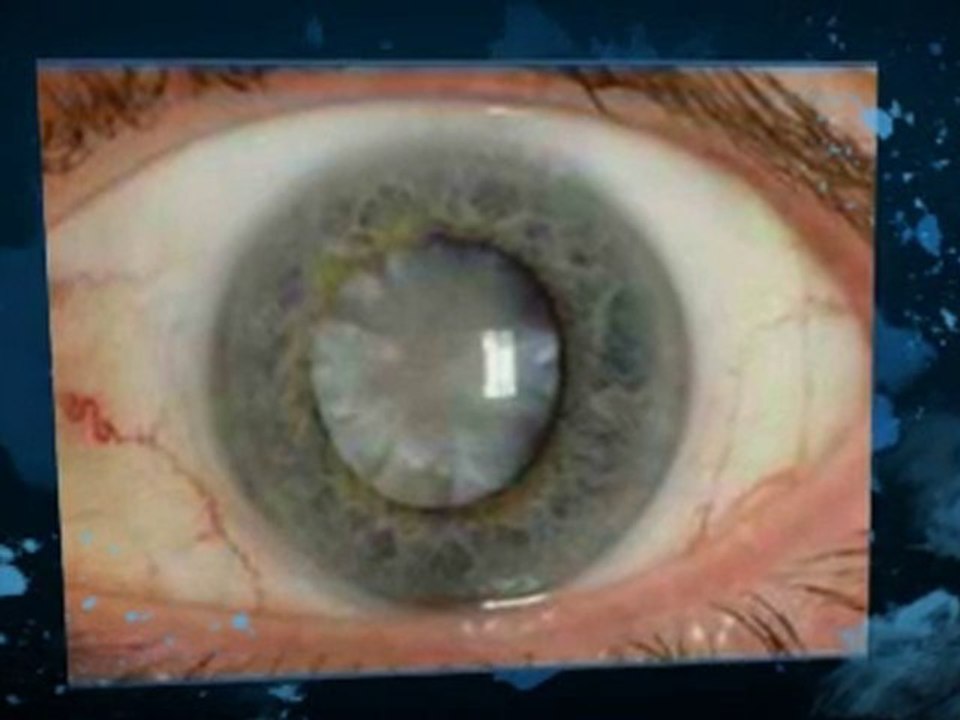 Can Steroids Heal Eczema Rashes?