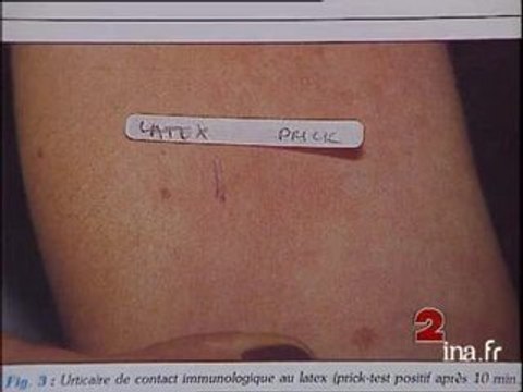 Info ? Intox ? allergique à la banane, allergique aux préservatifs