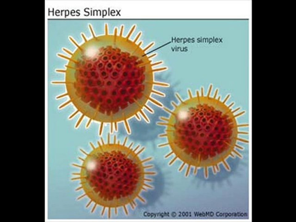 Herpes labial, herpes genital, tratamiento herpes,