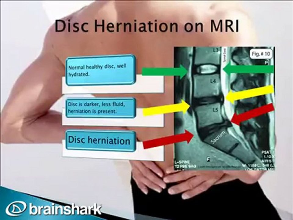 Spinal Decompression helps herniated discs