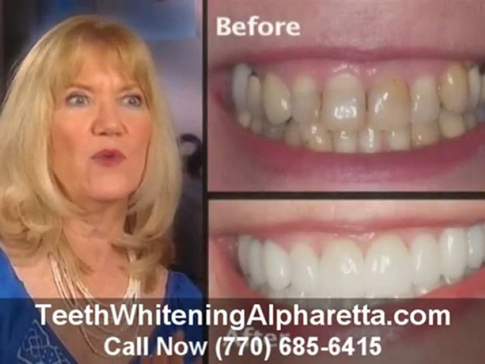 Teeth Whitening Alpharetta