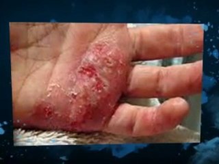 Understanding Dyshidrotic Eczema