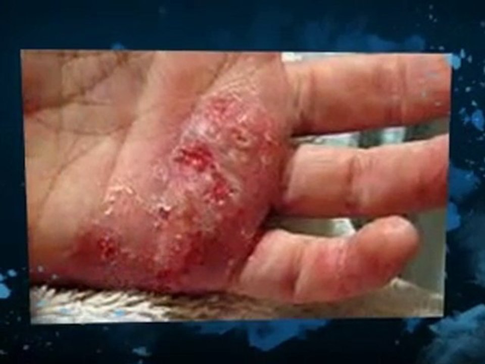 Understanding Dyshidrotic Eczema