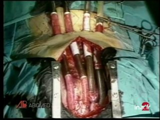 [Greffe coeur artificiel]