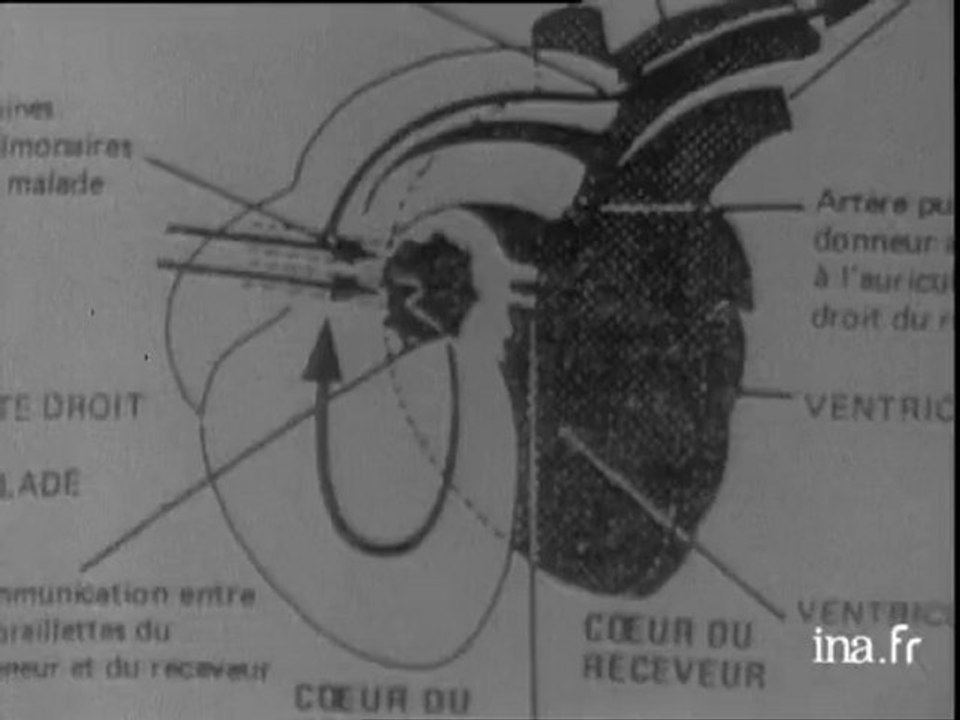 Coeurs de secours : greffes double-coeurs