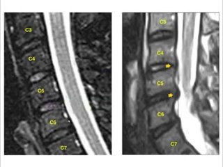Houston Attorney:  How A Neck or Back Injury is Proved ...
