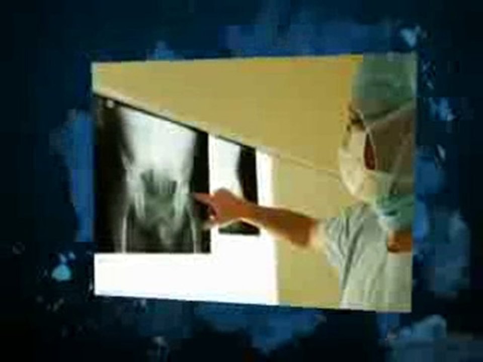 Depuy ASR Hip Recall