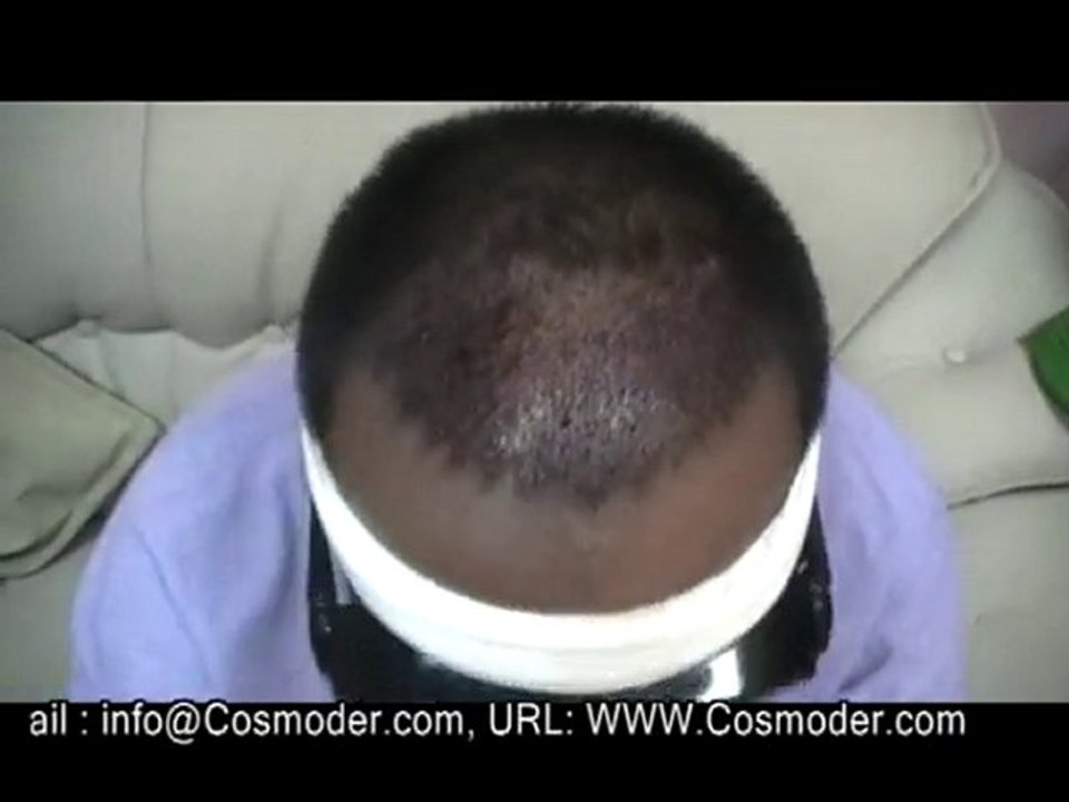 Hårtransplantasj Norway-Hair Transplant Pakistan Testimonial