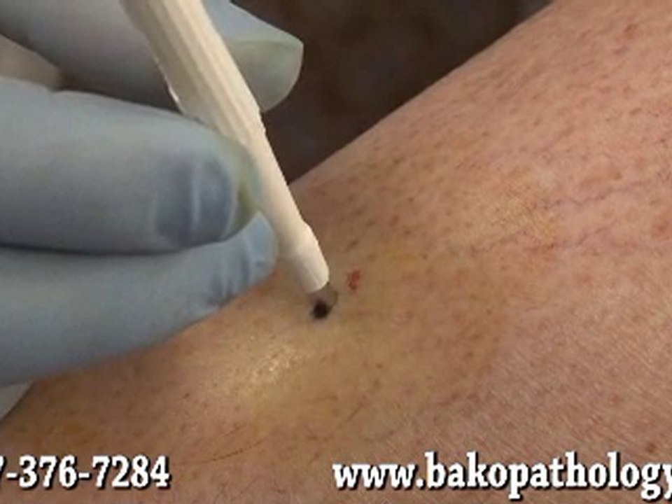 Bako Podiatric Pathology - Punch Biopsy, ENFD