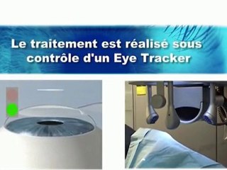 Opération laser des yeux