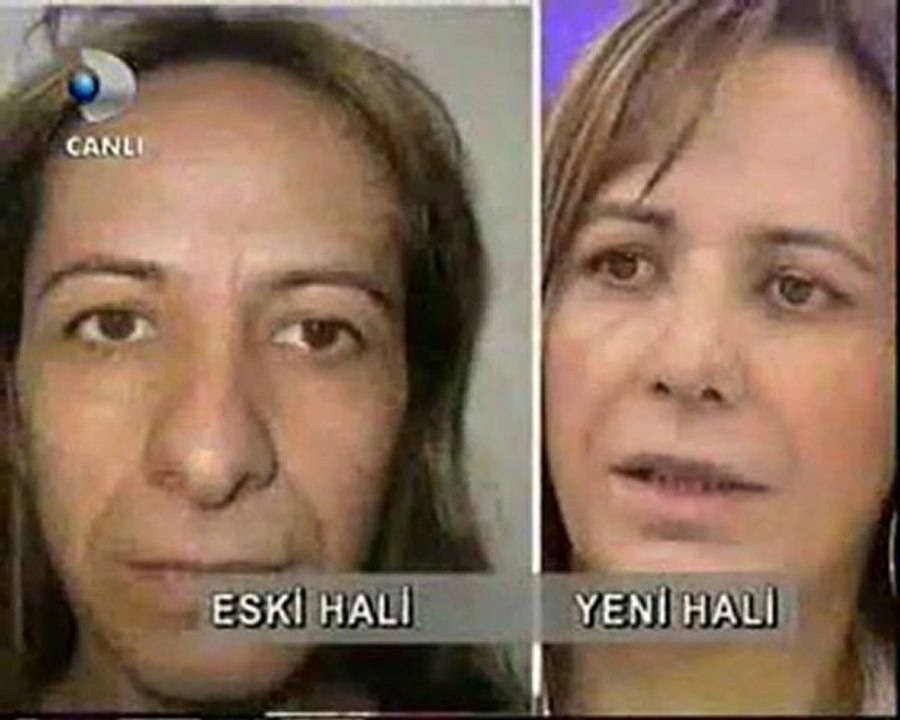 Burun Estetiği Öncesi Ve Sonrası Dr.Fatih DAĞDELEN - Video