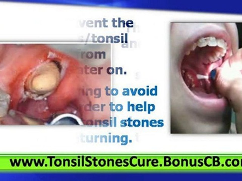 How to Remove Tonsil Stones - Tonsil Stones Removal Tonsil