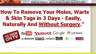 Plantar Wart Removal Surgery - How To Remove Moles Naturally