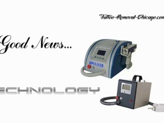 Laser Tattoo Removal Chicago