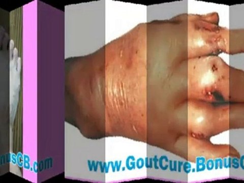 gout cure - gout treatment - gout removal - gout relief