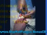 fungus toenails - nail fungus remedies