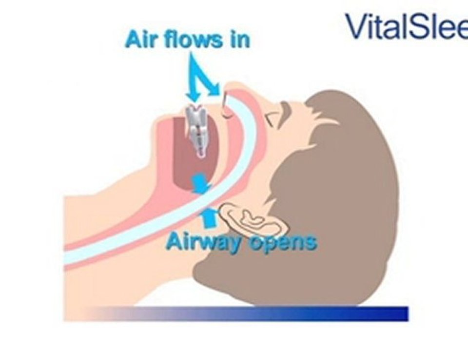 Anti-Snoring Mouthguard and Mouthpiece from VitalSleep