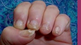 foot fungus cure - foot fungus removal
