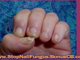 foot fungus cure - foot fungus removal