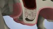 Implantologie dentaire : sinuslift greffe osseuse sinusienne
