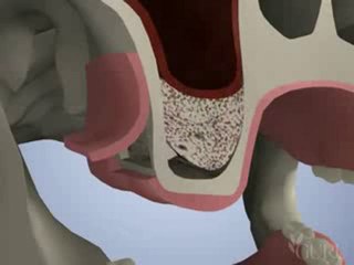 Implantologie dentaire : sinuslift greffe osseuse sinusienne