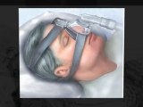CPAP nasal pillow & nasal masks
