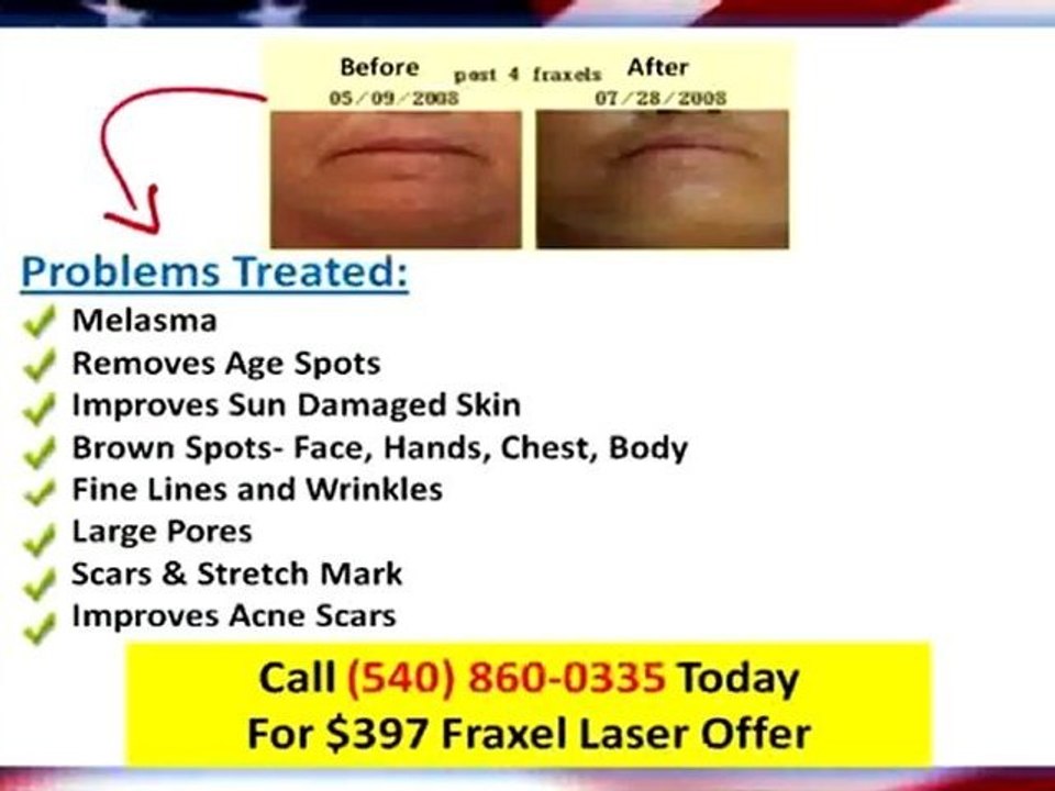 Laser For Skin Newport News VA|$397Fraxel Laser|Medi Spa