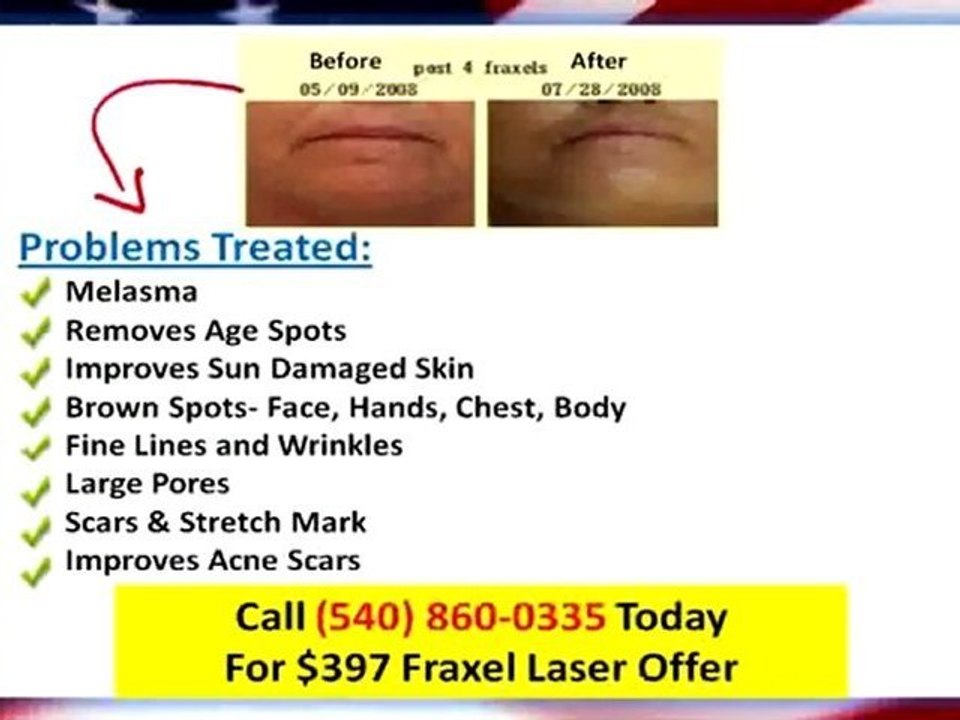 Acne Scar Removal Winchester VA|Fraxel Laser $397|Medi Spa