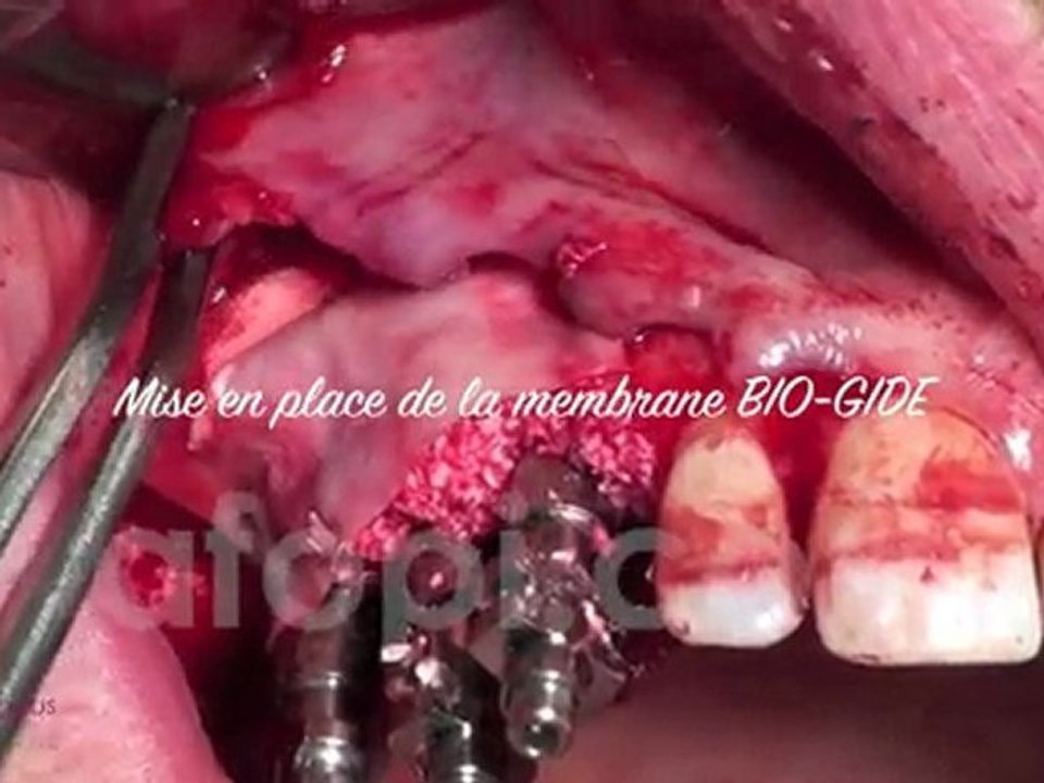 Gestion des alvéoles aux murs altérés - Dr. Jean-Louis Zadikian - Afopi Campus