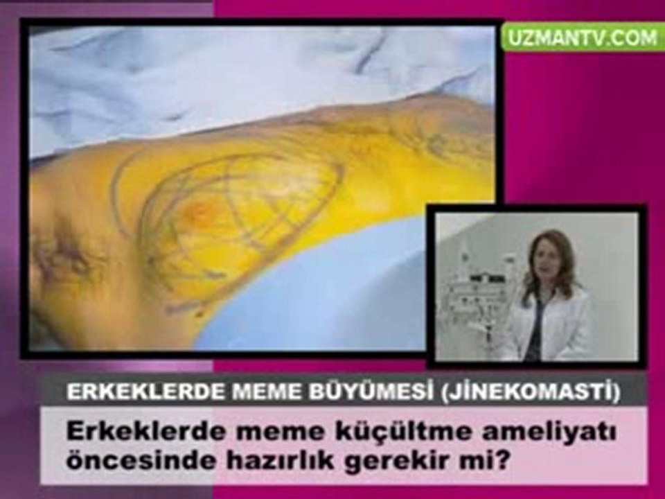 Erkeklerde meme kucultme ameliyatı-Op Dr Eser Aydogdu