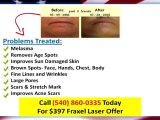 Laser Skin Rejuvenation Herndon Va|$397 Cosmetic Laser