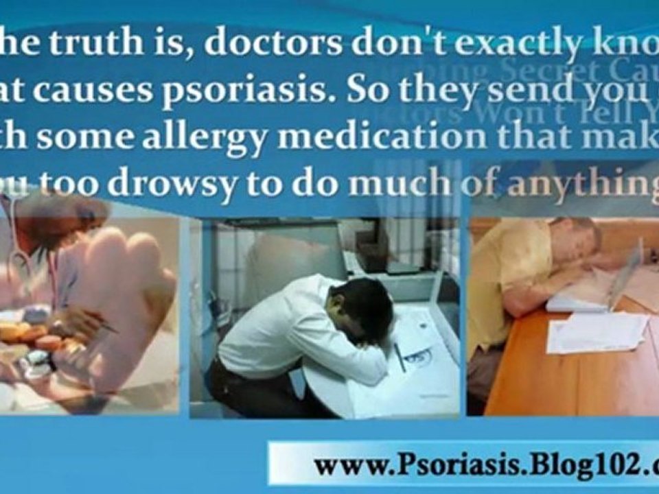 treatments for psoriasis - psoriasis remedies - psoriasis scalp