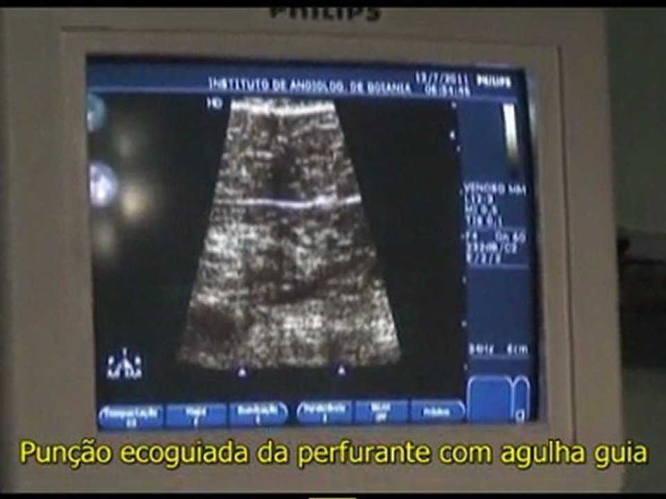 Tratamento / Cirurgia Laser Ecoguiada de Varizes (perfurante) - Dr.Eduardo Sisterolli (endolaser - EVLT)