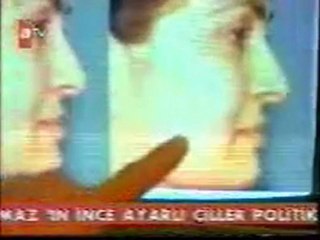 Liposuction Tedavisi ve Burun Estetiği