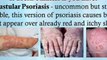 treatment for psoriasis - scalp psoriasis treatment - psoriasis on face