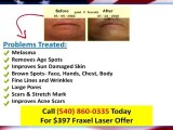 Laser Skin Rejuvenation Roanoke Va|$397 Cosmetic Laser